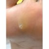 【魚の目対策】 注意しないといけないセルフケア！！！