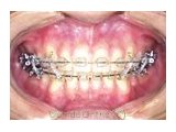 大人の歯（永久歯列）の矯正治療