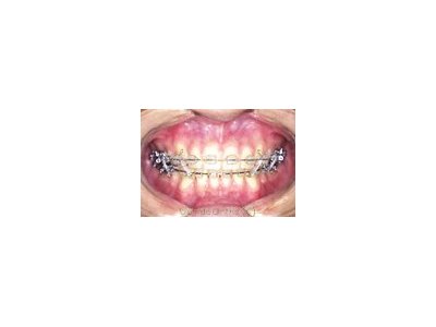 大人の歯（永久歯列）の矯正治療