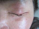 麦粒腫(ものもらい)施療例 第4日目