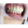 前歯二本を白いセラミックの歯に変えたい患者さん来院です。