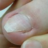 巻き爪が進行していくとこんな症状が出ます！