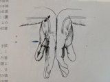 手首の痛み（手根管症候群）のカイロプラクティック
