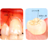 穴の開いた虫歯とどう違う？！初期虫歯