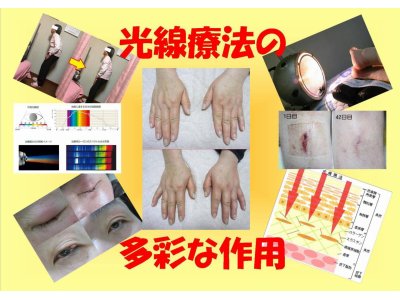 光線療法の多彩な作用