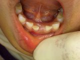 歯が内側から生えてきた！！