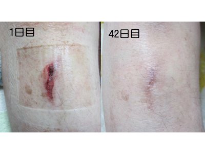 裂傷に対する光線療法⑥