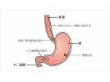 逆流性食道炎