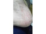 私の掌蹠膿疱症の痛みと田村先生のエゴスキュー