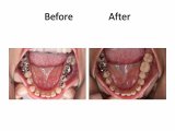 白い歯　Before&After
