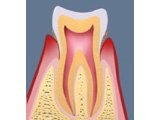 歯周病の進行と治療方法