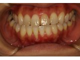 神田ふくしま歯科では歯ぐきの再生治療にこだわりがあります．