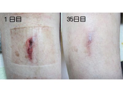 裂傷に対する光線療法⑤