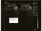 超音波画像診断症例検検討会 野球肘の靭帯の様子と腫脹