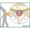 札幌 腰椎脊柱管狭窄症の原因-狭窄症候群