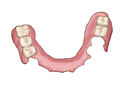入れ歯治療