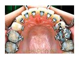 歯の裏側からの見えない矯正治療