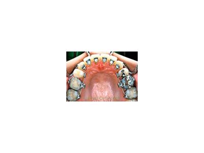 歯の裏側からの見えない矯正治療