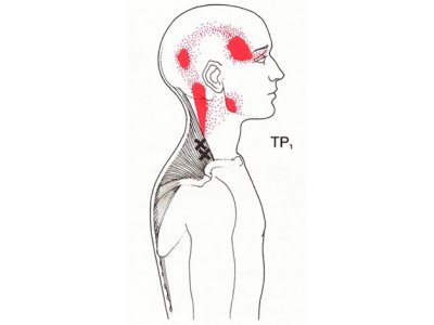 頭痛と筋肉の関係