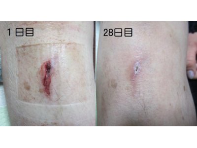 裂傷に対する光線療法④