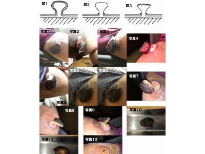 肉腫に対する光線療法