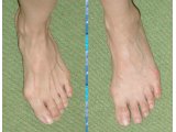 足指・足裏の矯正整体（外反母趾・内反小指など足先のトラブル）