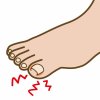 足専門の≪巻き爪対策と予防≫