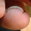 巻き爪は自然に治るの？