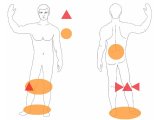 色素性絨毛結節性滑膜炎の光線療法