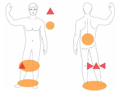 色素性絨毛結節性滑膜炎の光線療法